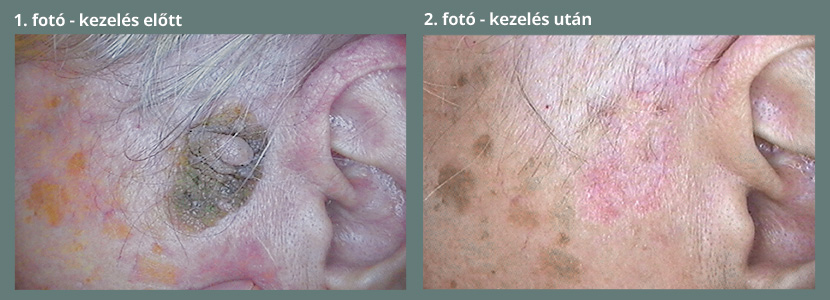 pikkelysömör fotók a kezelés előtt és után egészséges méhviasz krém propolissal pikkelysömörre